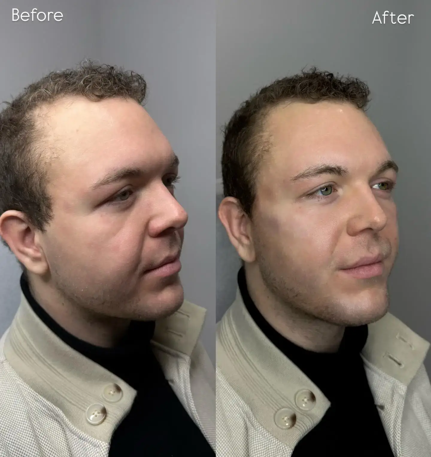 Labelled before and after three-quarter view of a male client's face and jawline at Aesthetic Nurse Marta, Vaughan