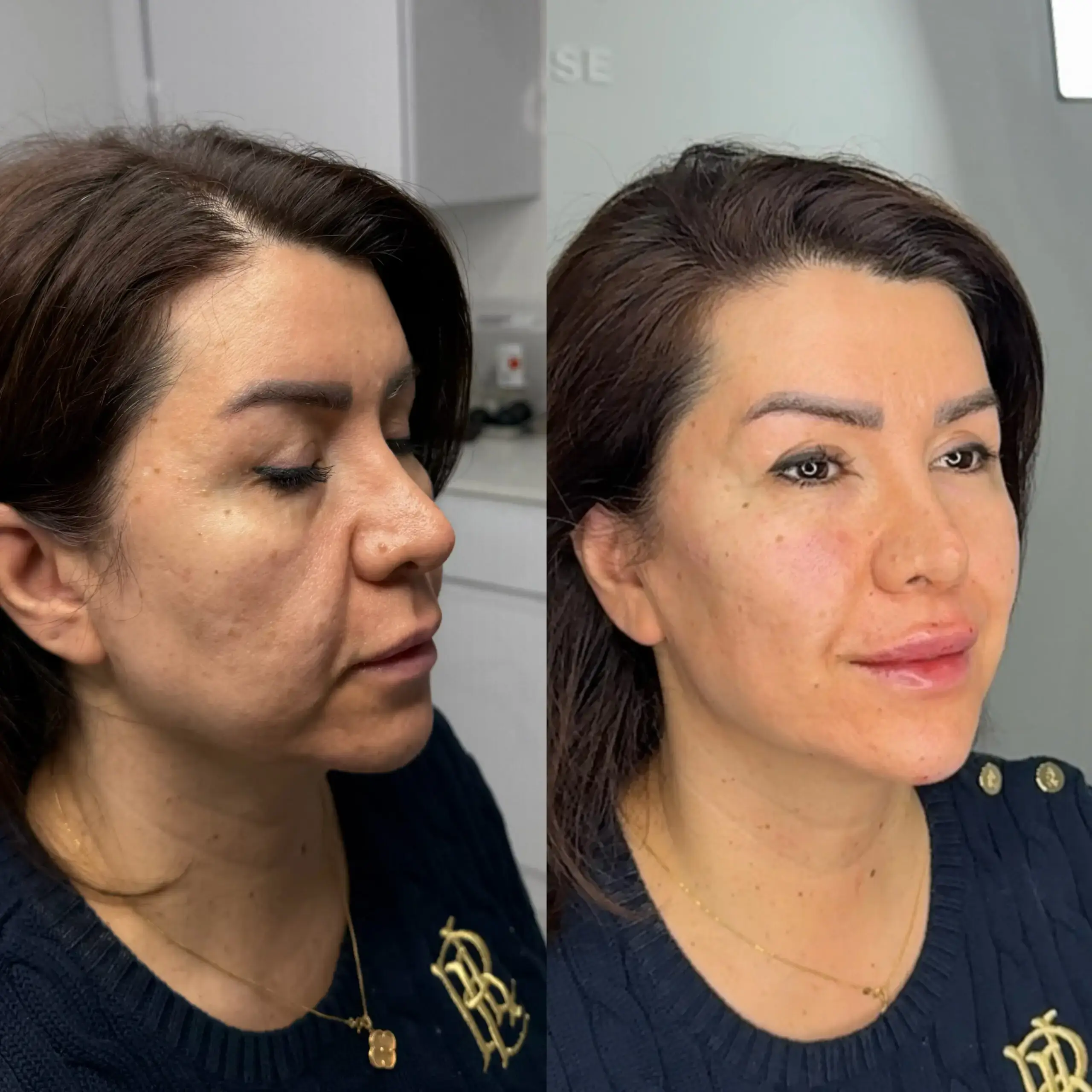 Before and after three-quarter view of a mature female client's face and jawline at Aesthetic Nurse Marta, Vaughan