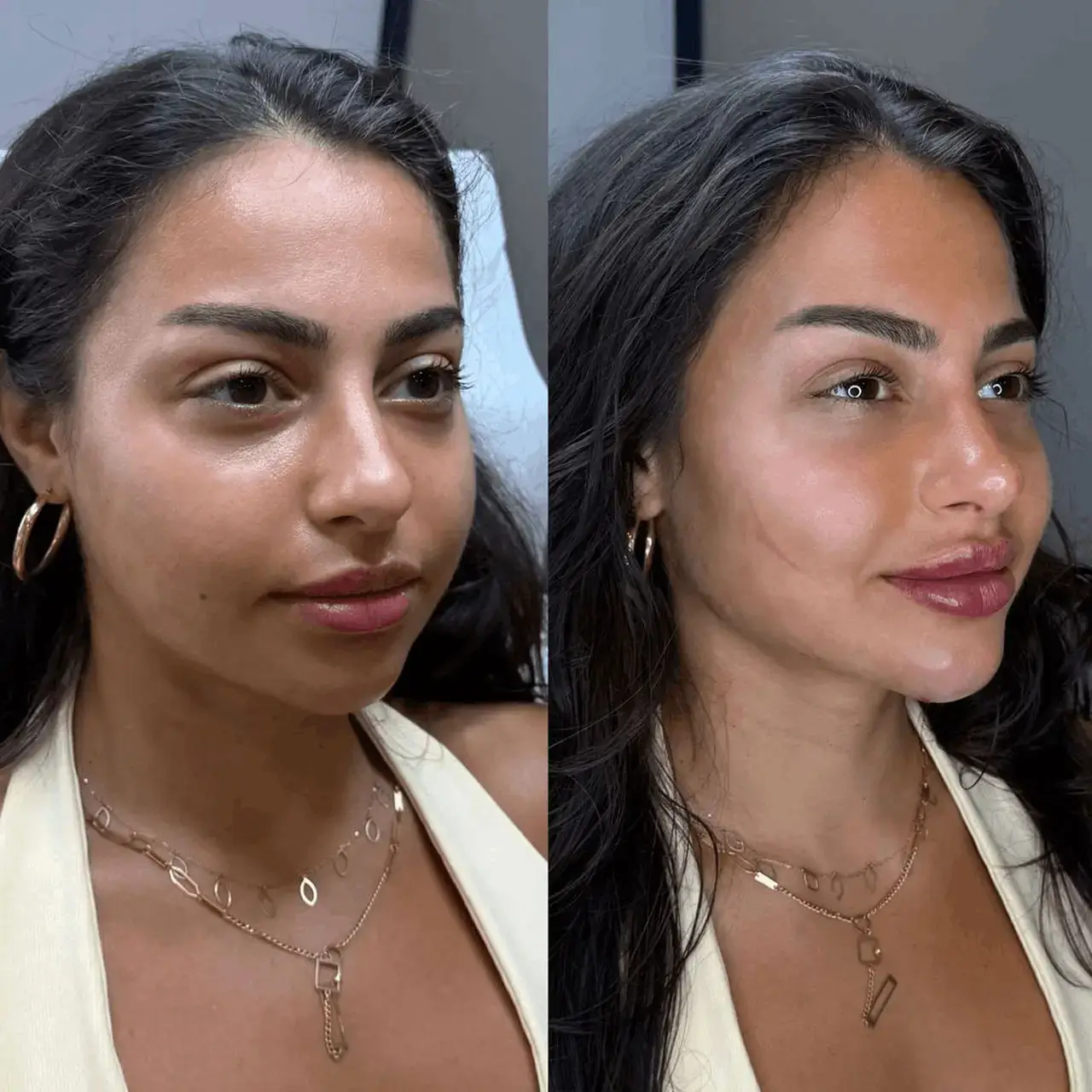 Before and after three-quarter view of a female client's cheeks, lips and jawline, hoop earrings, Aesthetic Nurse Marta