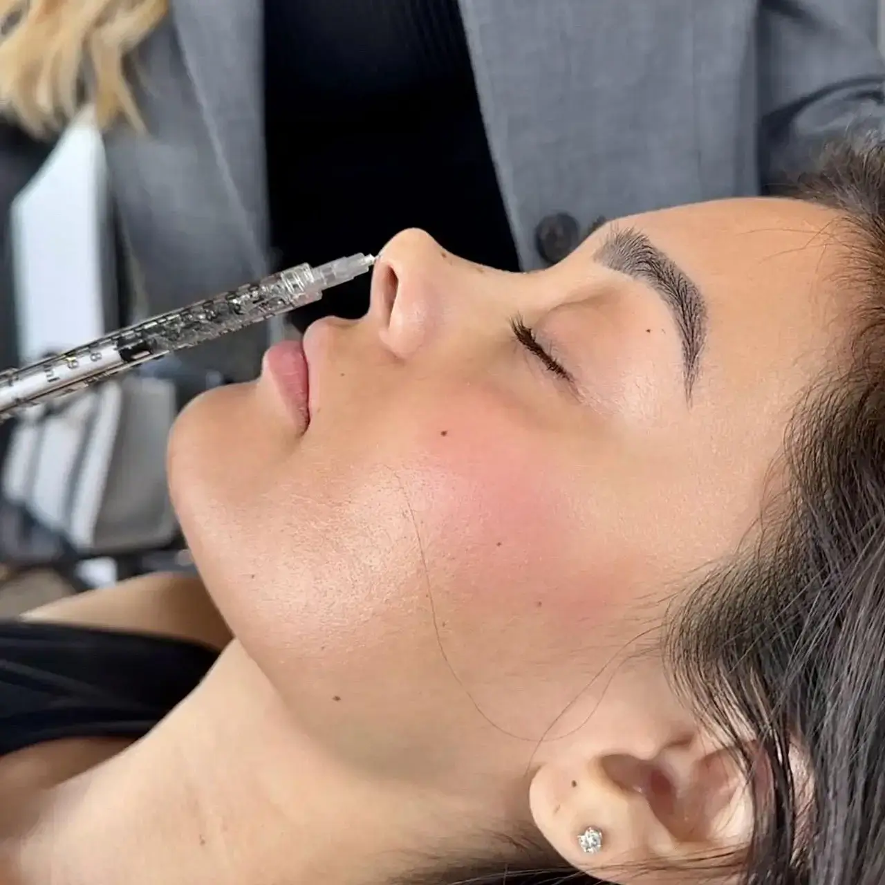 Injection at the tip of the nose of a reclining client, with an injector in a grey blazer standing behind