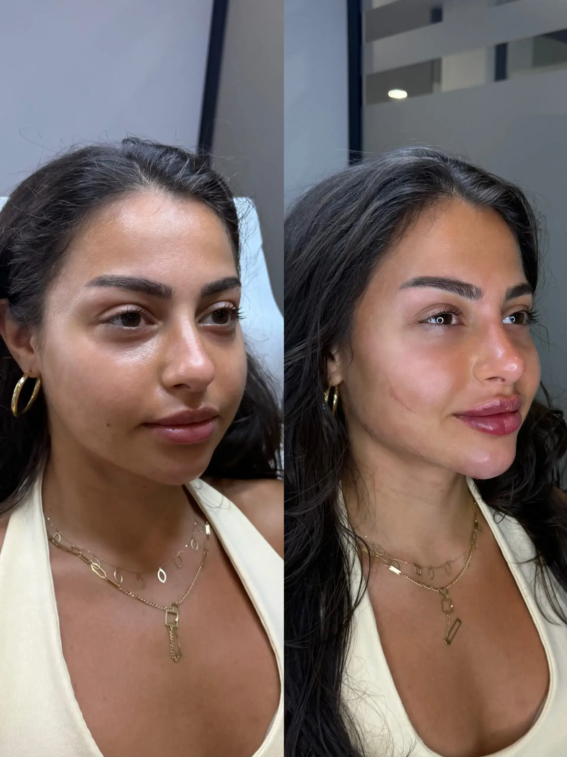 Before and after three-quarter view of a female client's cheeks, lips and jawline, hoop earrings, Aesthetic Nurse Marta