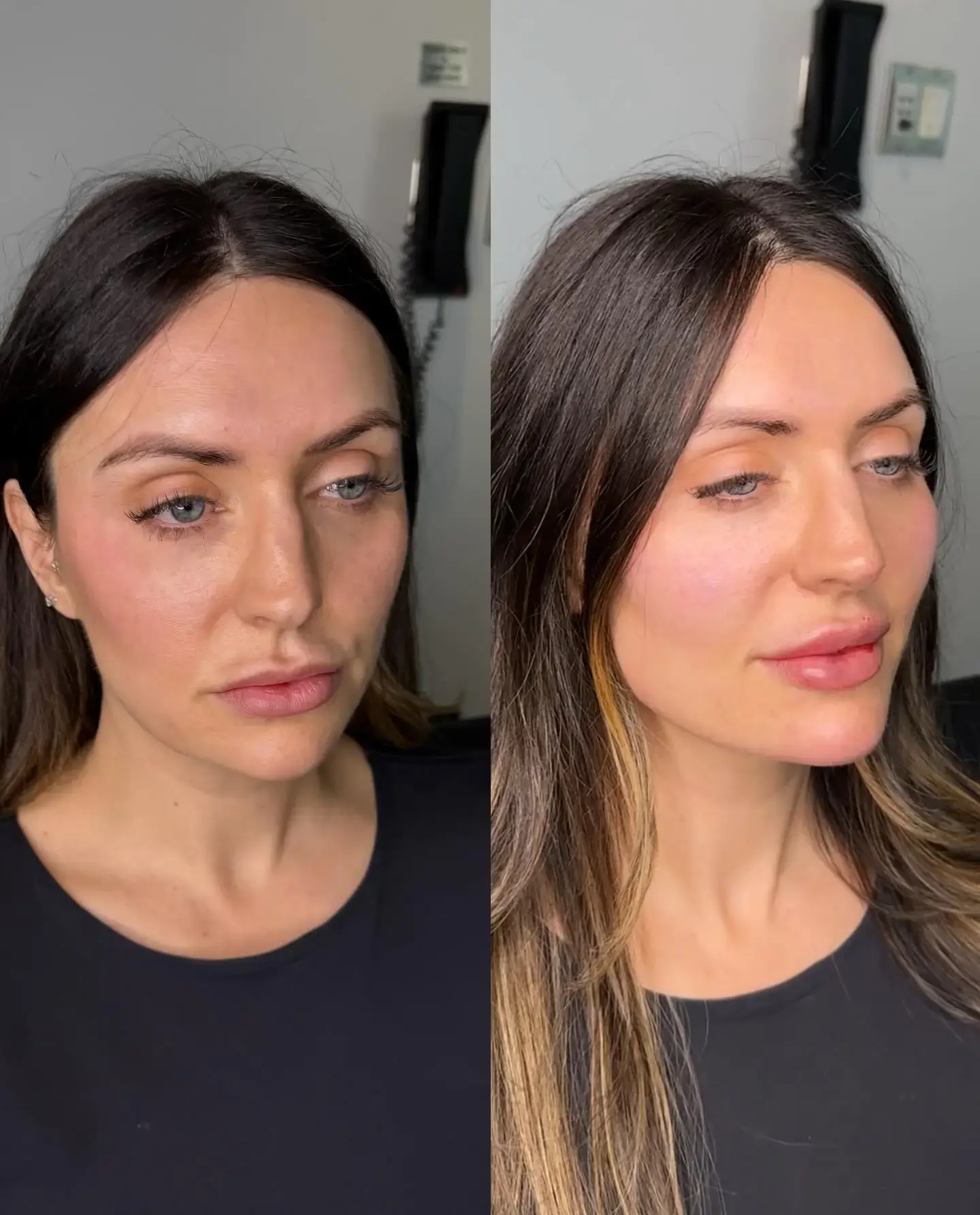 Before and after three-quarter view of a female client's face and lips at Aesthetic Nurse Marta in Vaughan