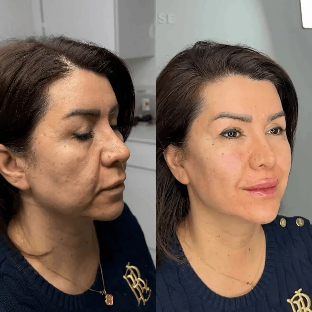 Before and after three-quarter view of a mature female client's face and jawline at Aesthetic Nurse Marta, Vaughan