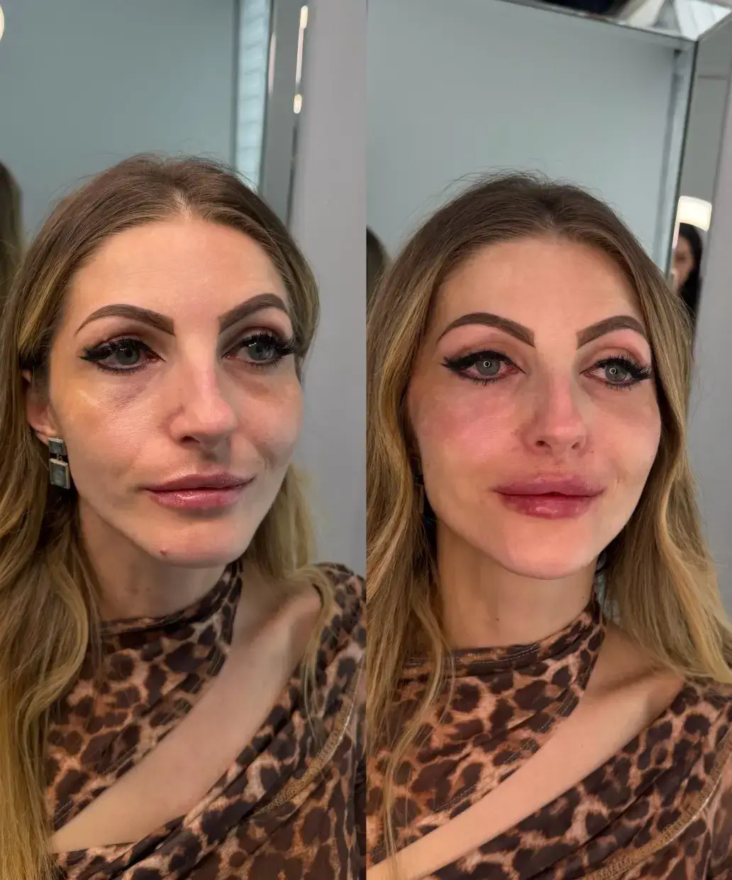 Before and after front view of a female client's lips and lower face, with mild redness after treatment, Vaughan