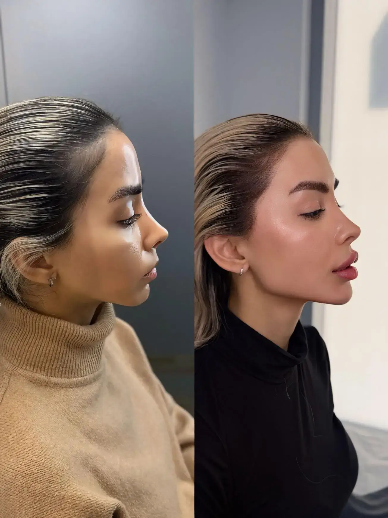 Before and after side profile of a young female client's nose, lips and chin at Aesthetic Nurse Marta, Vaughan