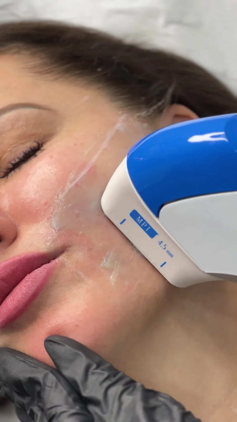 Ultraformer MPT 4.5 mm cartridge lifting the cheek and jawline