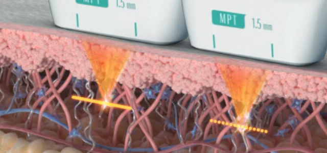 Ultraformer MPT Micro-Pulsed mode versus Normal mode thermal points in the skin, Classys illustration