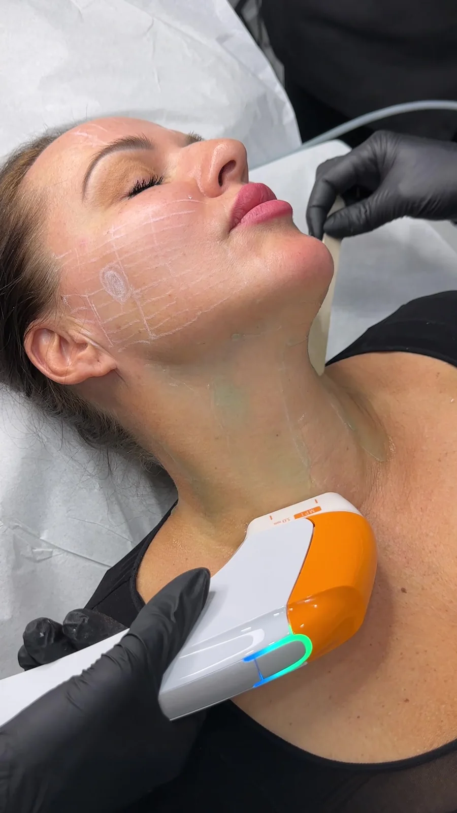 Ultraformer MPT neck tightening treatment with an MPT cartridge, Vaughan